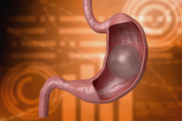 Intragastric Balloon Placement