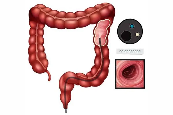 Colonoscopy