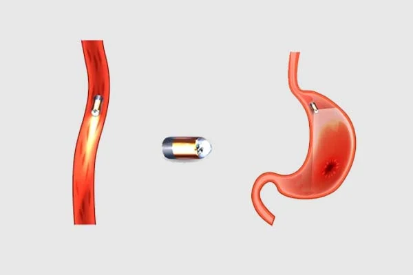 Capsule Endoscopy
