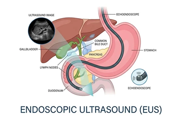 Endoscopic Ultrasound