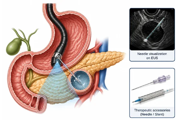 Interventional EUS