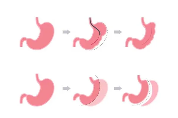 Endoscopic Weight Loss Procedures